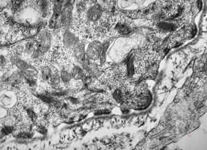 F,23y. | hemidesmosomes, basement membrane and anchoring fibrils … normal oral mucosa